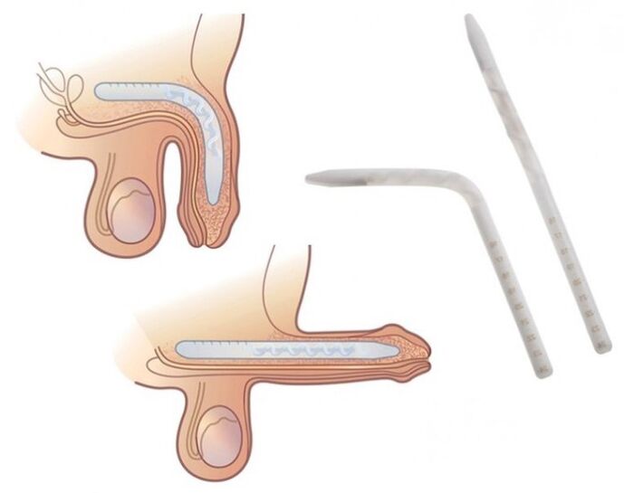 Falloplasty, lai palielinātu locekli