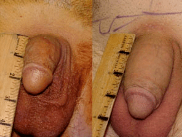 Pirms un pēc lipofilēšanas un gēla implantācijas