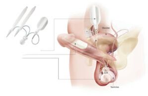 implantu ievietošana dzimumloceklī